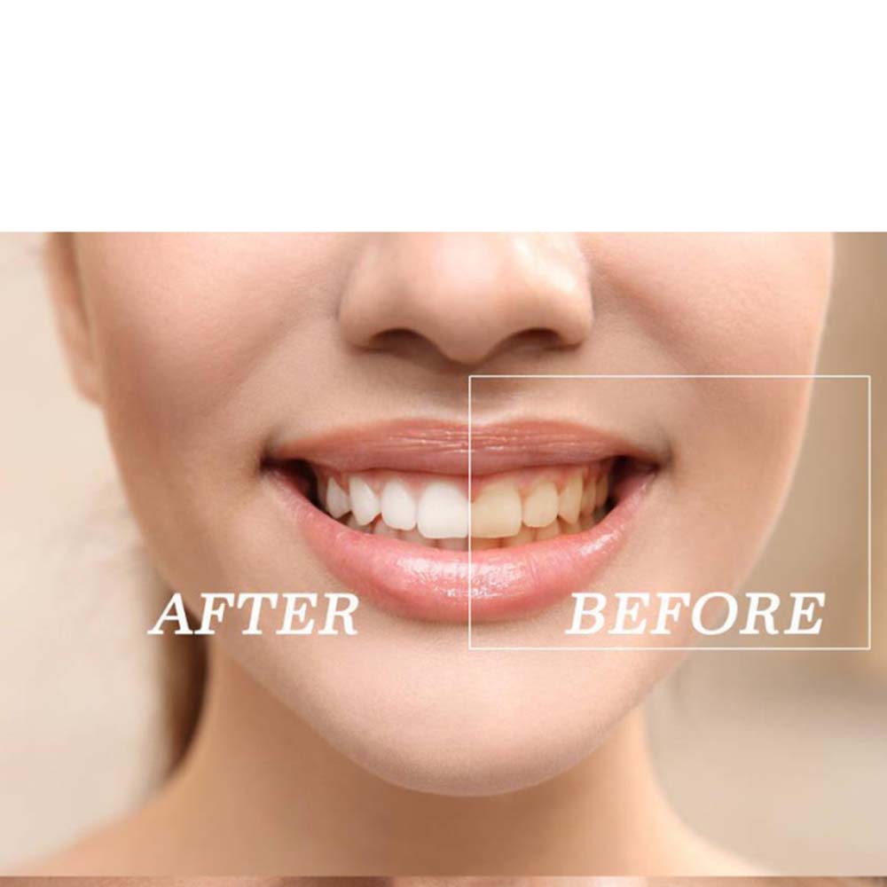 Kit Gel pemutih gigi peroksida - Teeth Whitening With Peroxide ulasan dan harga
